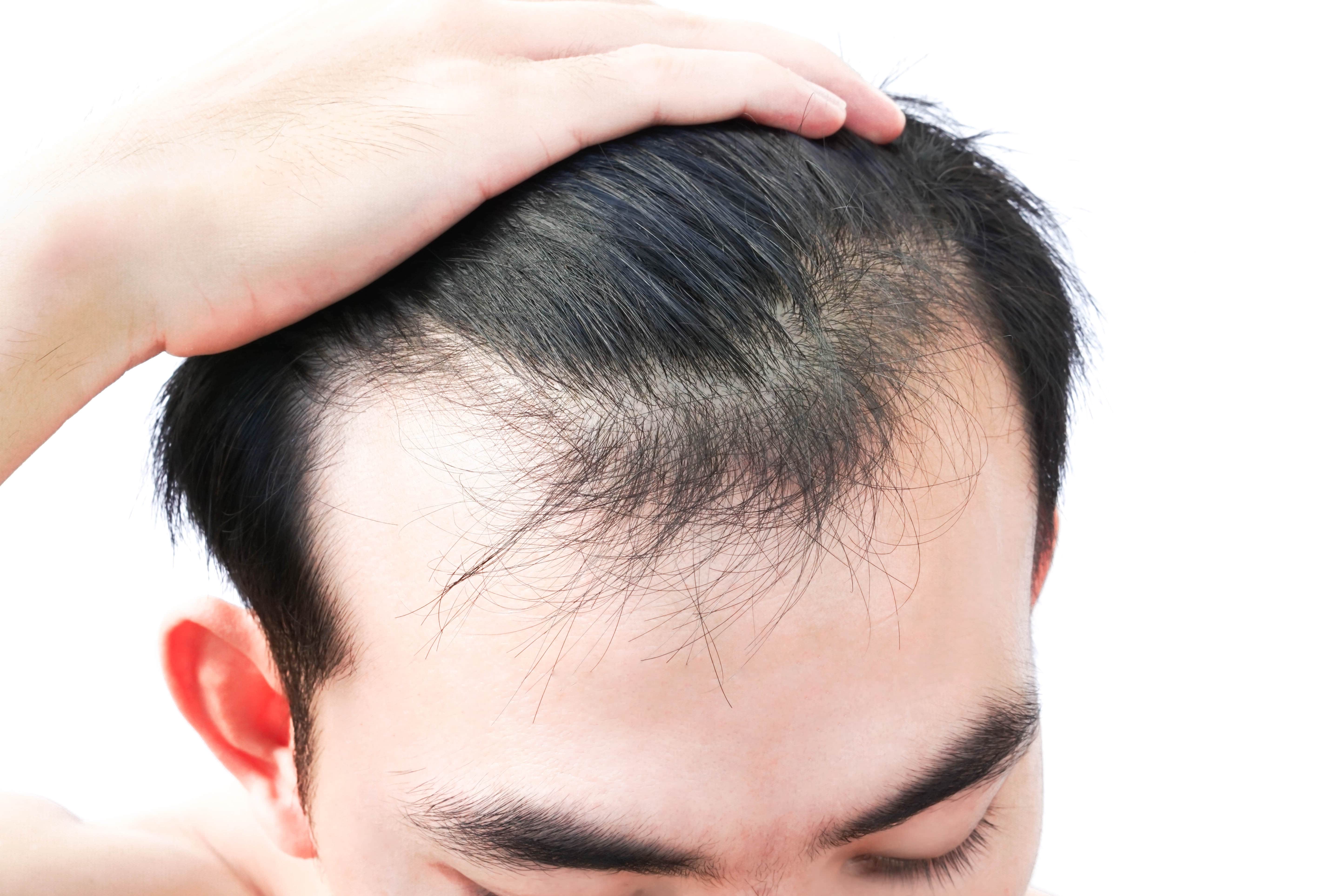 erkek tipi saç dökülmesi tedavisi varmı
