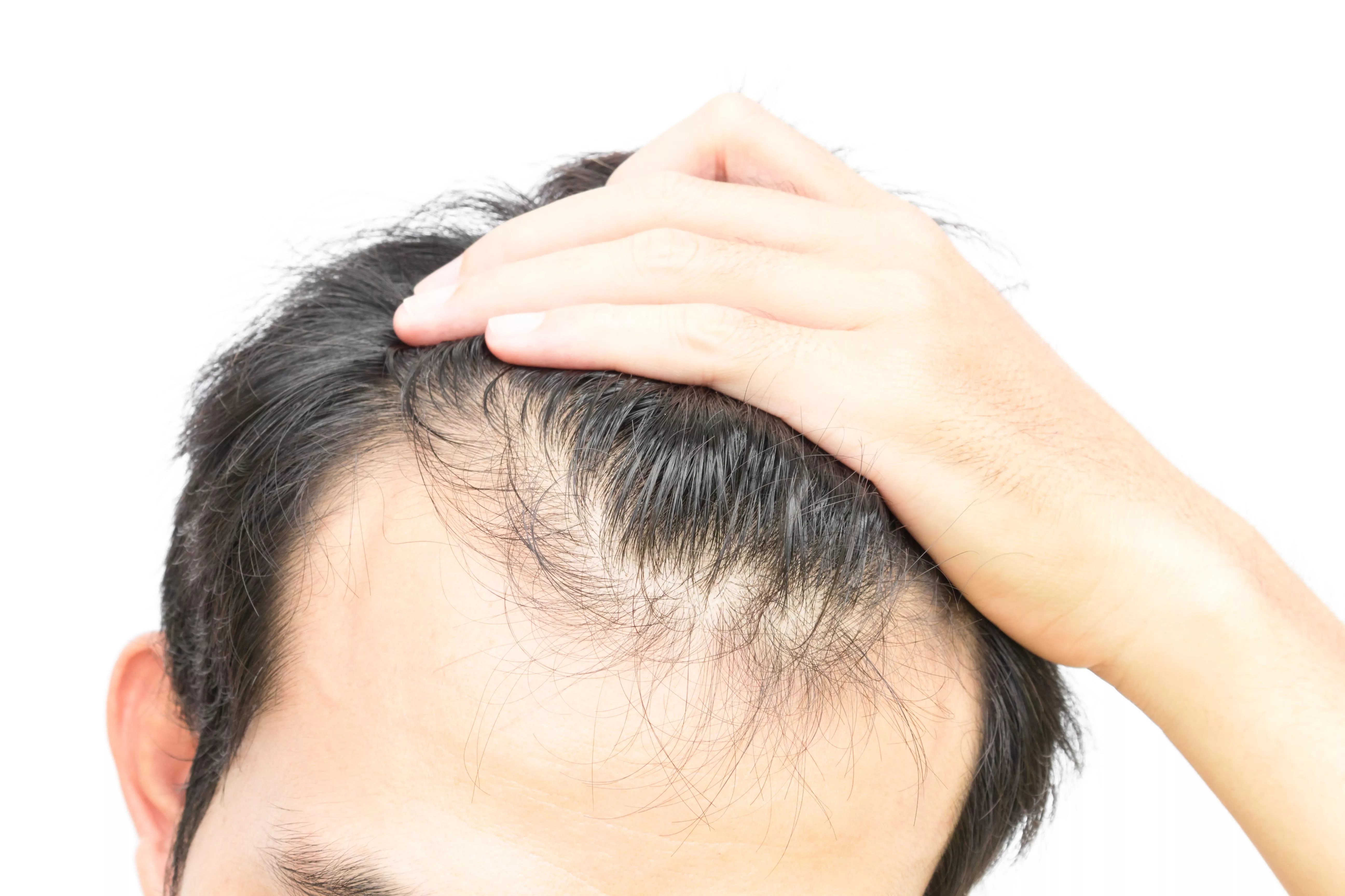 Erkek Tipi Saç Dökülmesi, Androgenetik Alopesi ve Klinik belirtileri