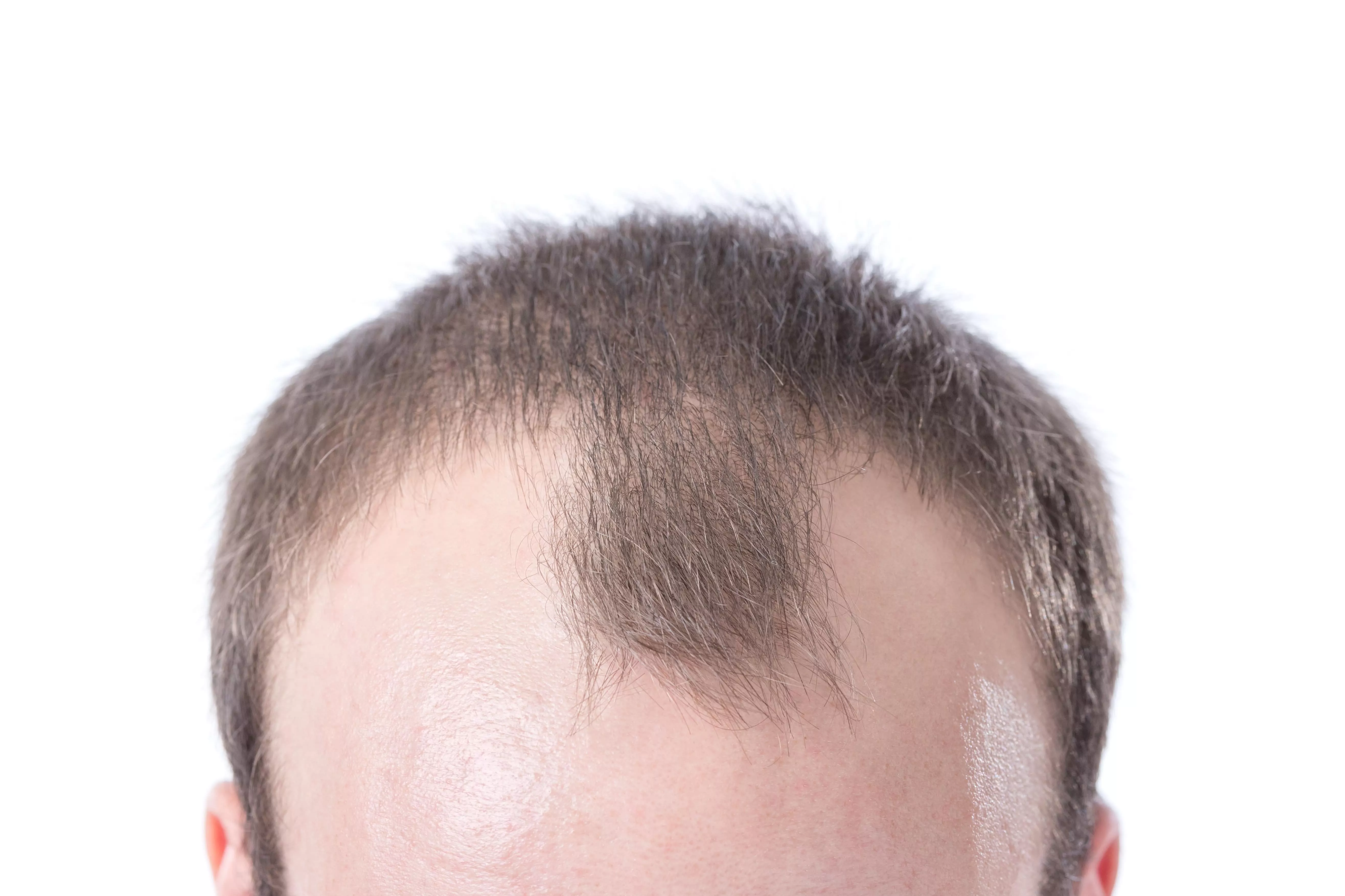 Erkek Tipi Saç Dökülmesi, Androgenetik Alopesi (AGA)
