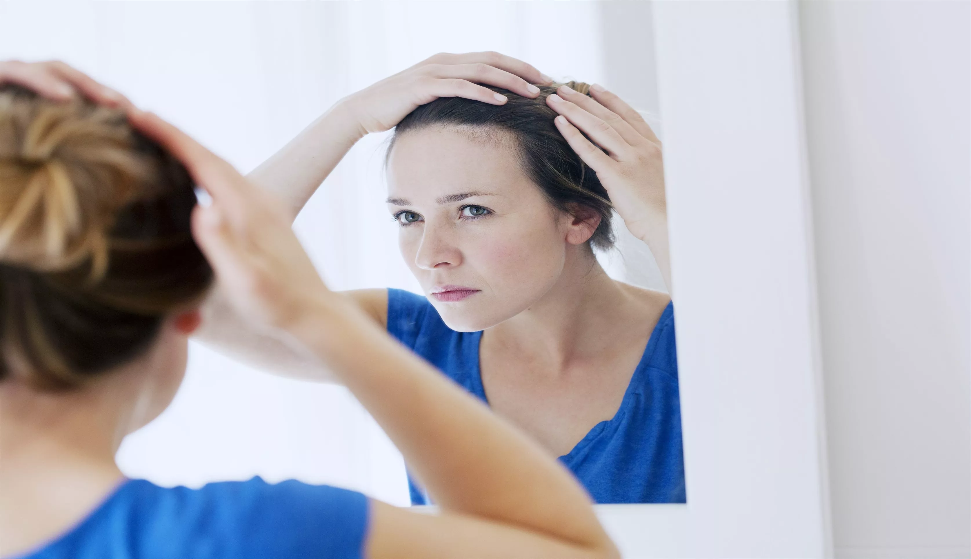 Kadın Tipi Saç Dökülmesi, Telogen Effluvium ve Klinik belirtileri