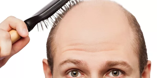 Saç Dökülme Tipleri Nelerdir?
