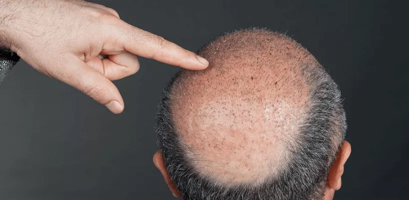 Saç Ekimi Tedavi Süreci Ne Kadardır? 