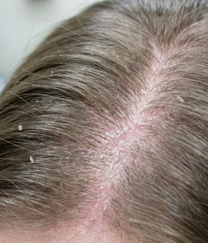 Saçta Egzama Neden Olur? Saç Egzamasına Ne İyi Gelir?