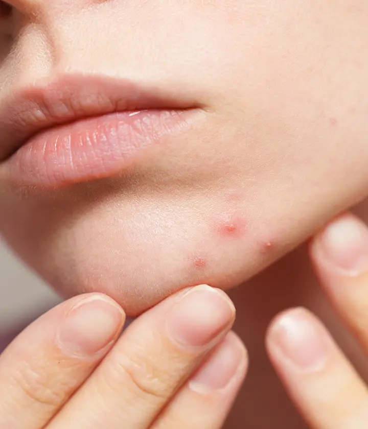 Hormonal Akne Nedir?