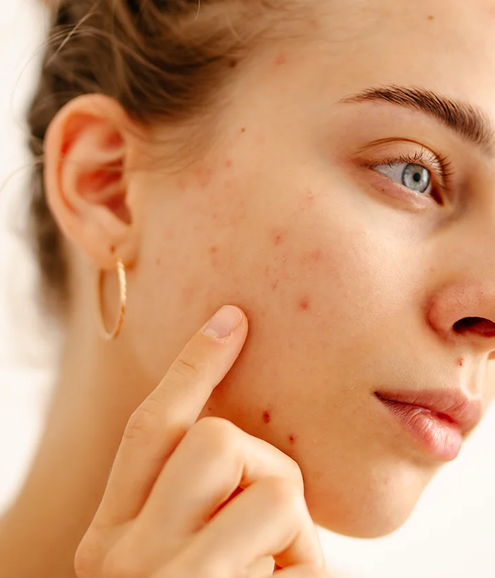 Sivilce Kremi Hangi Özelliklere Sahip Olmalı: Dermatolog Önerileri